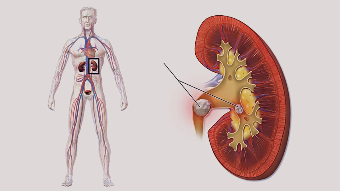 কিডনিতে পাথর হলে