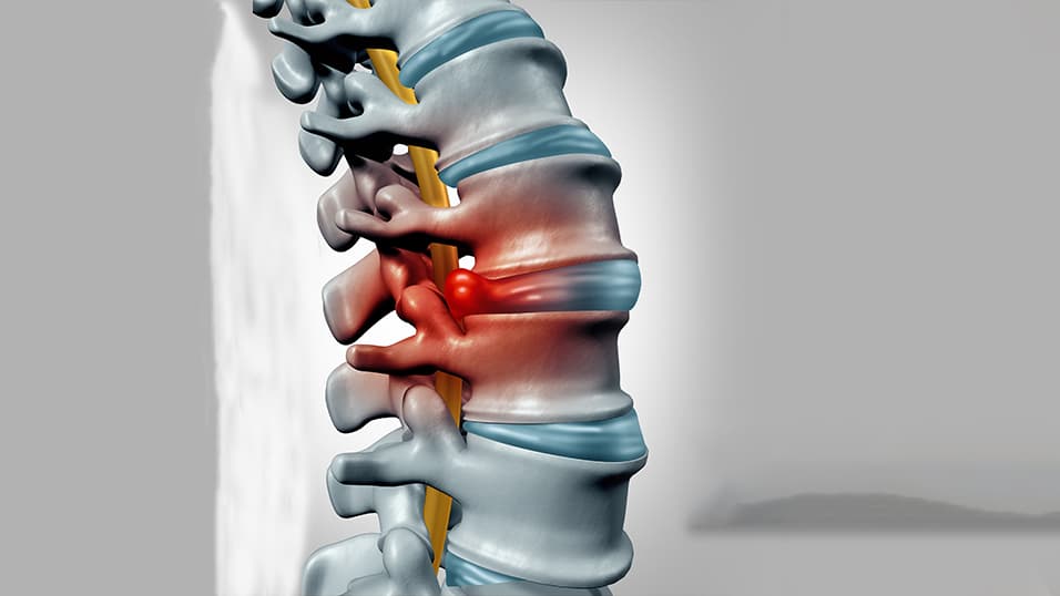 ডিস্ক প্রলেপসের ব্যথার কারণ ও লক্ষণ