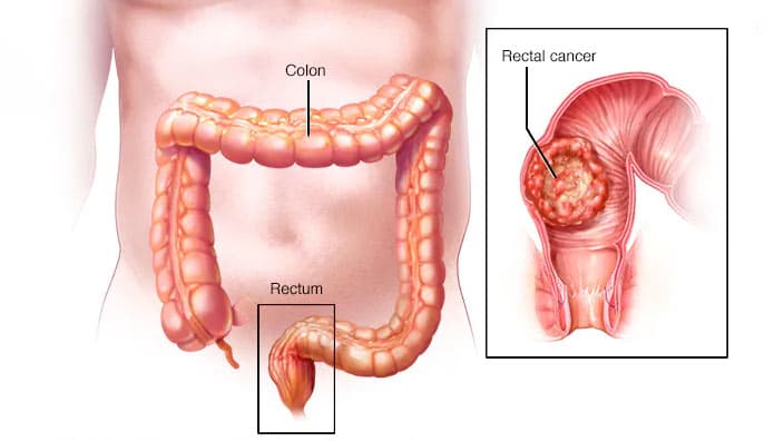 রেকটাম ক্যানসার: দেশেই উন্নত চিকিৎসা