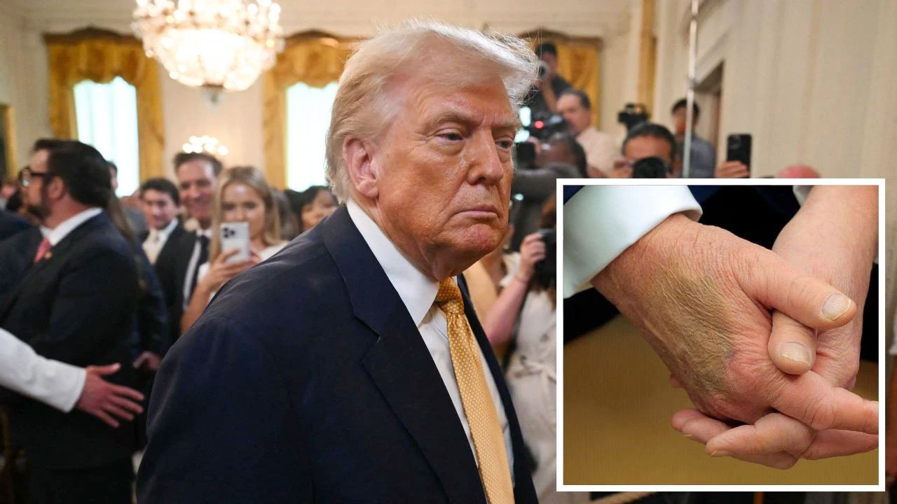 ট্রাম্পের হাতে কালশিটে, এক পা ফোলা, শিরার রোগে আক্রান্ত মার্কিন প্রেসিডেন্ট