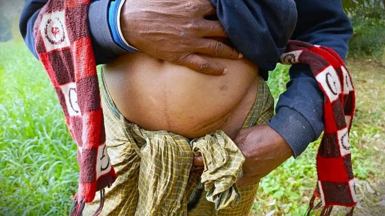 সফিরুদ্দিন তাঁর কিডনি দেওয়ার অপারেশনের চিহ্ন দেখাচ্ছেন। ছবি: আল-জাজিরা
