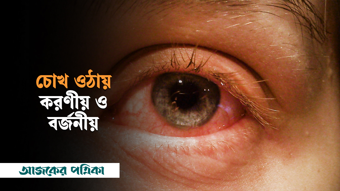 চোখ কেনো ওঠে, করণীয় ও বর্জনীয় কী