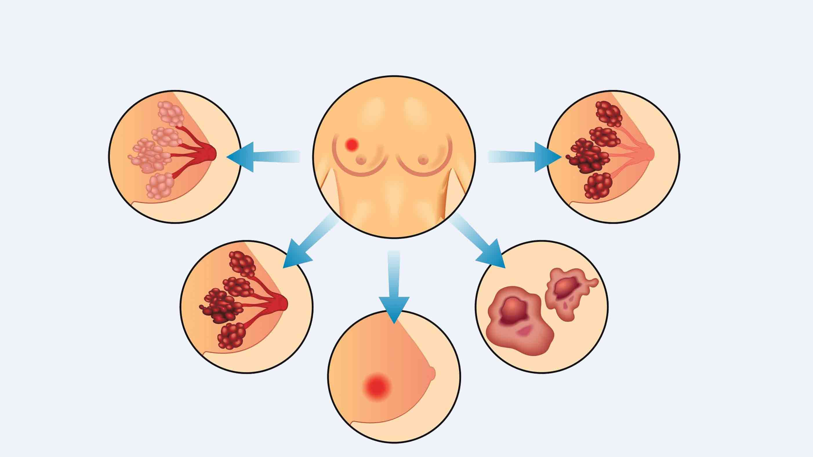 Breast-cancer