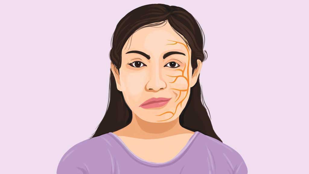 মুখ বেঁকে যাওয়া রোগের চিকিৎসা