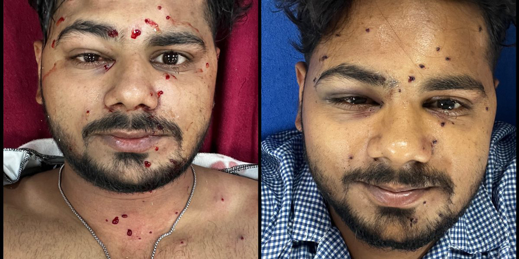 দিল্লিতে বিক্ষোভের সময় পেলেট গান ব্যবহারের অভিযোগ, আহত তরুণ