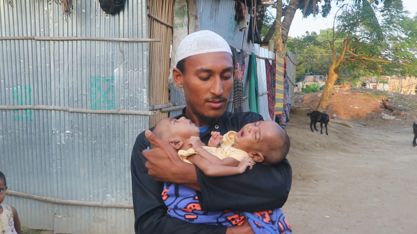 ঢামেকে এনেও বাঁচানো গেল না জোড়া লাগা দুই যমজ শিশুকে