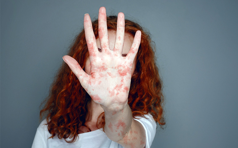 ১৯৭০-এর আগে জন্মগ্রহণকারীরা কেন প্রাকৃতিকভাবে হাম প্রতিরোধী