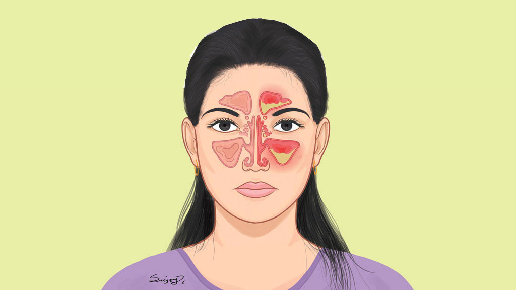 গরমে সাইনোসাইটিসের ব্যথা থেকে বাঁচার উপায়