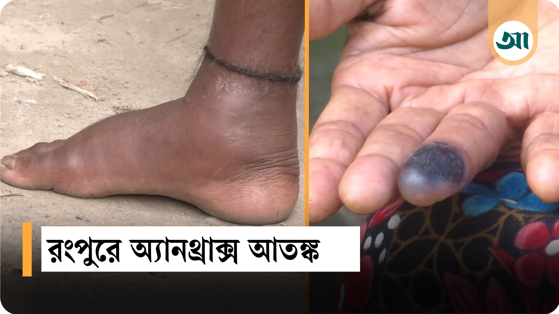 রংপুরে অ্যানথ্রাক্স আতঙ্ক: পীরগাছায় উপসর্গ নিয়ে ২ জনের মৃত্যু, আক্রান্ত ১১ জন
