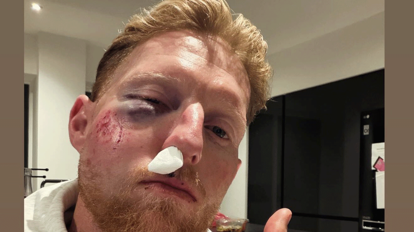 বেন স্টোকসের মুখের এমন বেহাল দশা কেন