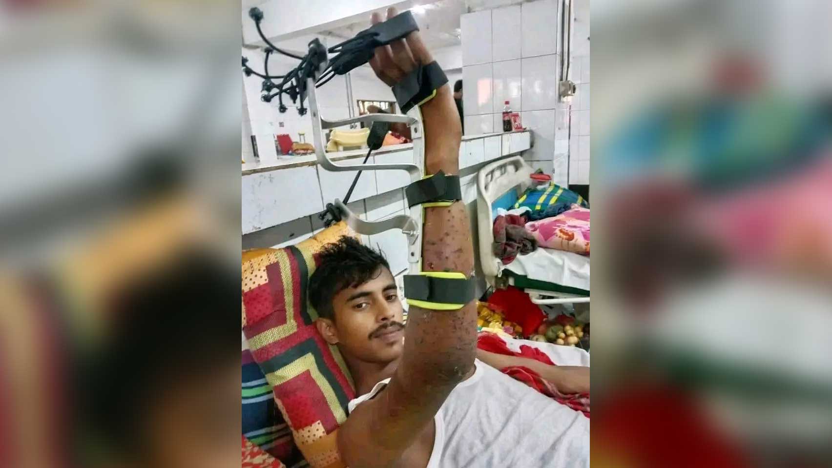শরীরে ৪০০ স্প্রিন্টার, যন্ত্রণায় ঘুমাতে পারেন না জুলাই যোদ্ধা হাসান