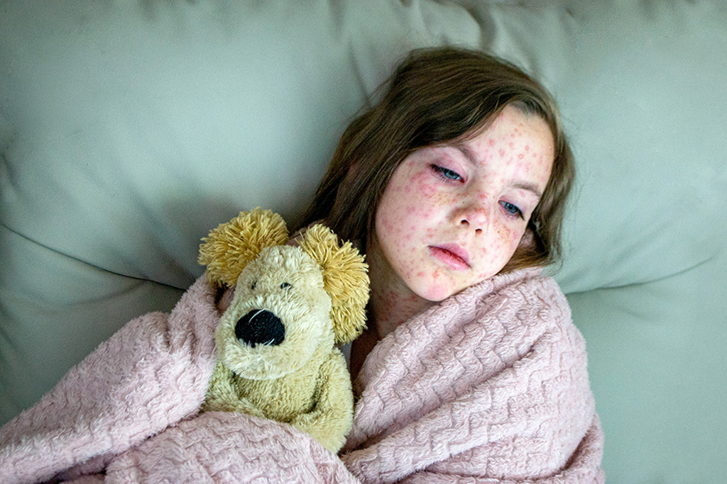 বিশ্বজুড়ে হামের ভয়াবহ প্রত্যাবর্তন, কারণ কী