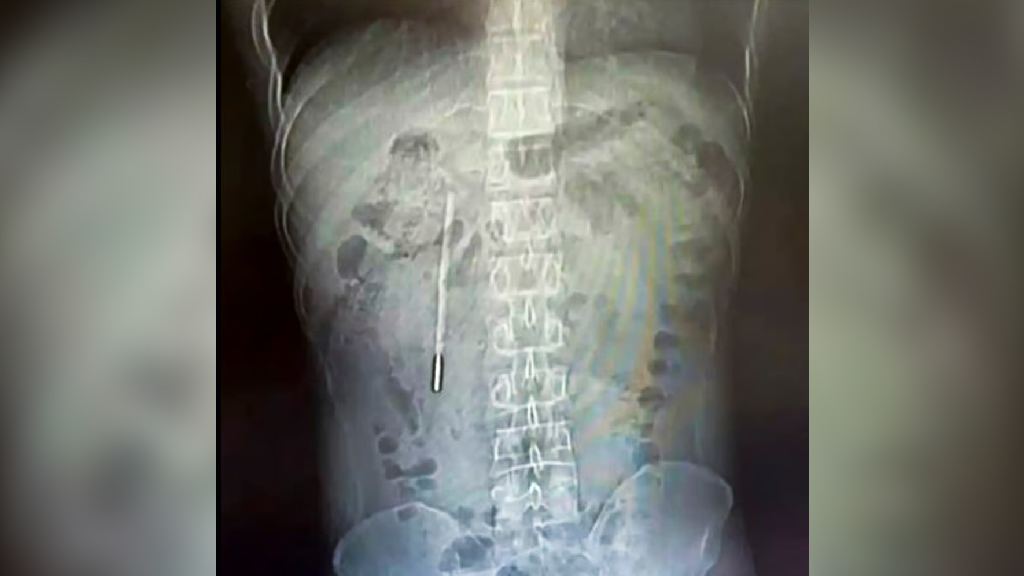 শৈশবে গিলে ফেলা থার্মোমিটার ২০ বছর পর ২০ মিনিটের অস্ত্রোপচারে উদ্ধার