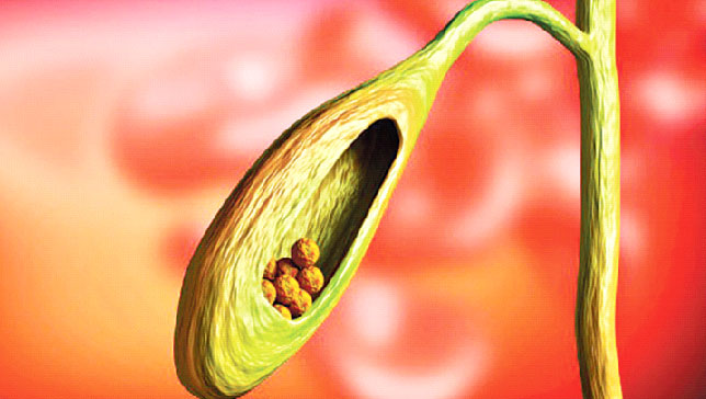 পিত্তথলিতে পাথর