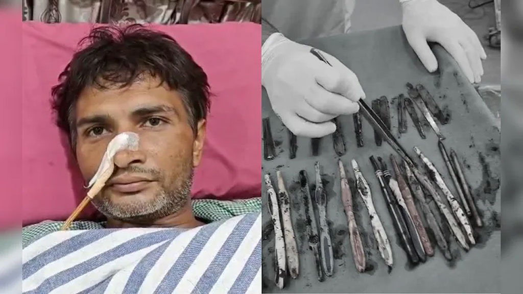 পেটের ক্ষুধায় খেয়েছেন ২৯ চামচ, ১৯ টুথব্রাশ