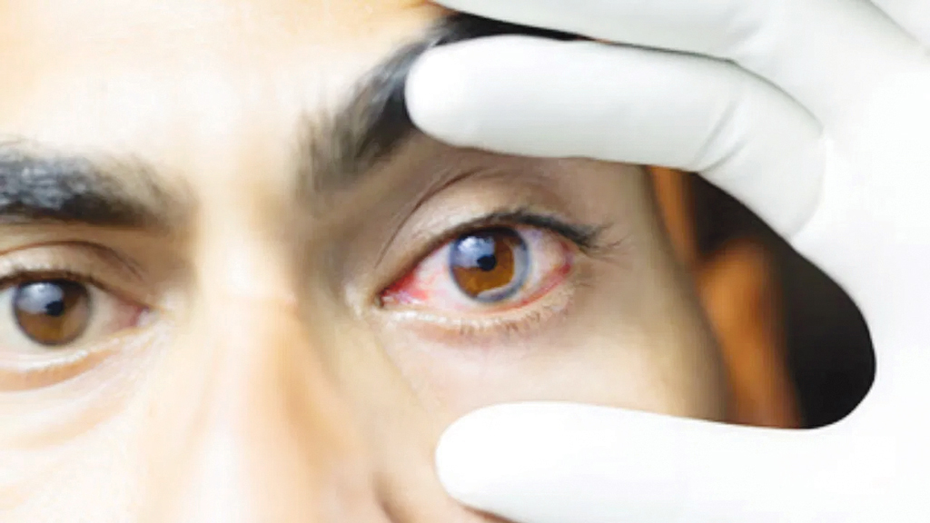 চোখের যেসব রোগ পুরুষদের বেশি হয়