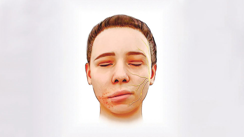 র‍্যামজি হান্ট সিনড্রোমের লক্ষণ ও চিকিৎসা