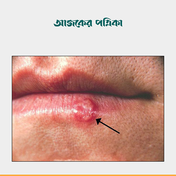 ঠোঁটে হারপিসের সক্রিয় ঘা থাকা ব্যক্তির কাছ থেকে নবজাতকের শরীরে HSV-1 সংক্রমণ ছড়াতে পারে। প্রতীকী ছবি