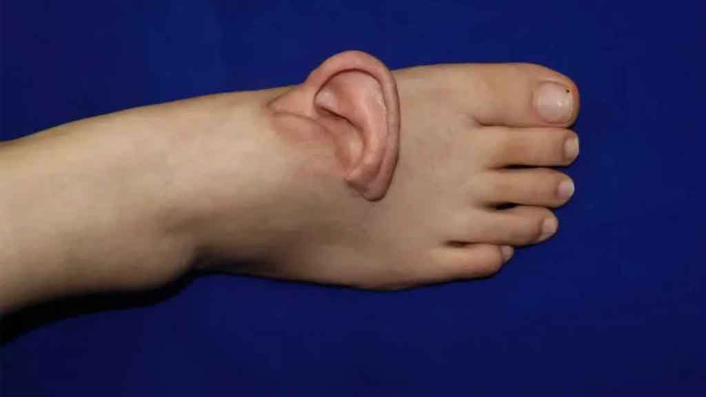 প্রথমবারের মতো বিচ্ছিন্ন কান পায়ে প্রতিস্থাপন, ফের যথাস্থানে স্থাপন