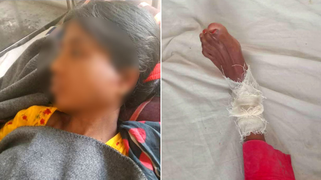 দাম্পত্য কলহ, স্ত্রীর পায়ের রগ কেটে দিলেন স্বামী