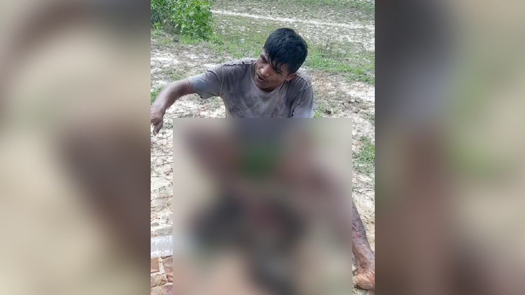 উখিয়া সীমান্তে স্থলমাইন বিস্ফোরণ, রোহিঙ্গা যুবকের পায়ের গোড়ালি বিচ্ছিন্ন