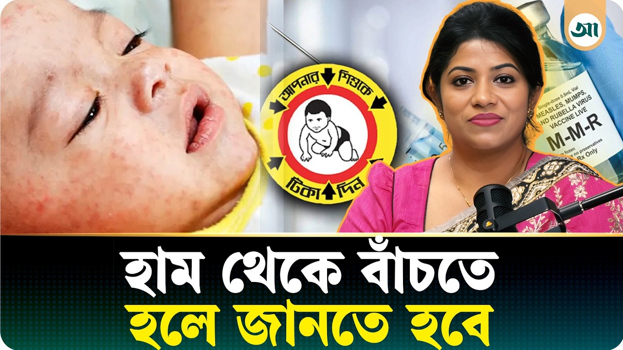 হাম অত্যন্ত সংক্রামক, একজন আক্রান্ত মানুষ ১২-১৮ জনকে সংক্রমিত করতে পারে