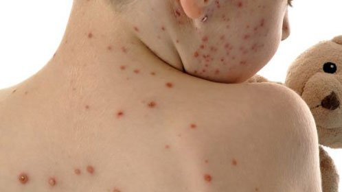 পাবনায় হঠাৎ করে বেড়েছে হামের প্রাদুর্ভাব, হাসপাতালে ভর্তি ২৭ রোগী