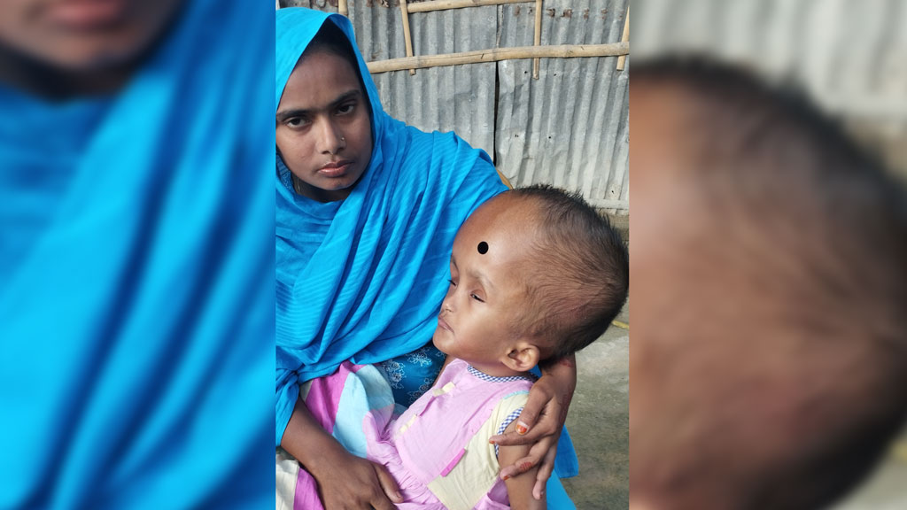 হাইড্রোসেফালাসে আক্রান্ত আয়শার চিকিৎসা বন্ধ, অর্থাভাবে মানবেতর জীবন