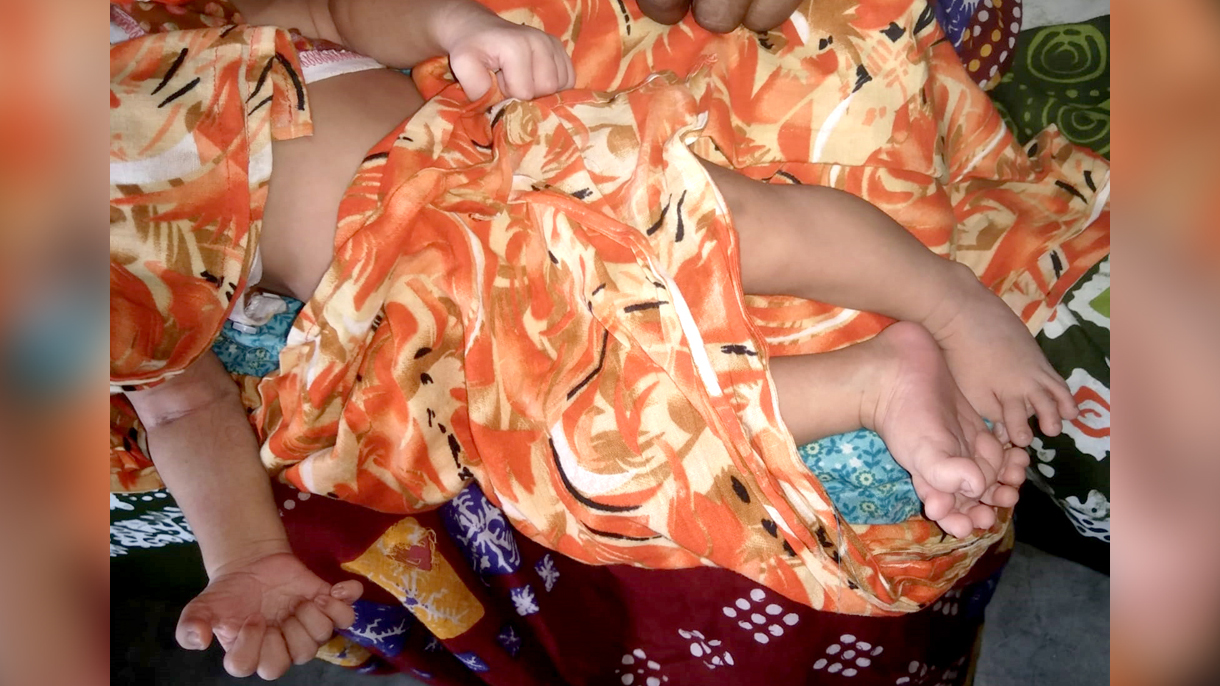 ২৮ আঙুল নিয়ে নবজাতকের জন্ম