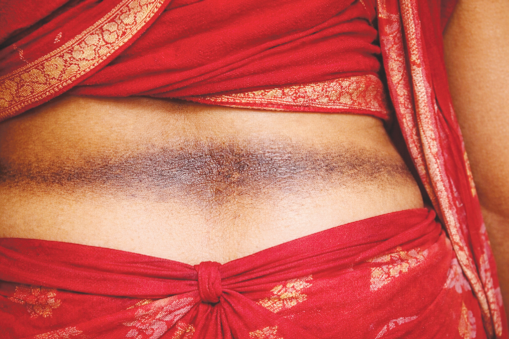 দীর্ঘদিনের অবহেলায় হতে পারে শাড়ি ক্যানসার