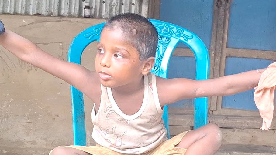 দুই হাত বাঁধা শিশুর জীবন, অর্থাভাবে পাচ্ছে না চিকিৎসা
